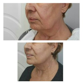 Before and after Botox injections at CE International Hospital, visible facial wrinkle reduction result