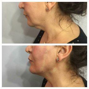 Before and after Botox injections at CE International Hospital, visible neck and jawline lift result