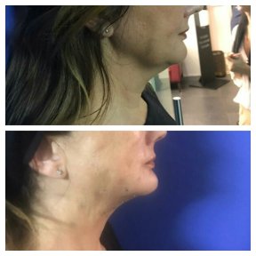 Before and after Botox injections at CE International Hospital, visible jawline tightening result