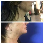 Before and after Botox injections at CE International Hospital, visible jawline tightening result