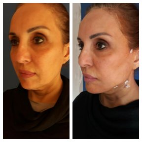 Before and after Botox injections at CE International Hospital, facial rejuvenation results