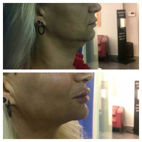 Before and after Botox injections at CE International Hospital, visible jawline tightening result
