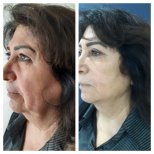 Before and after Botox injections at CE International Hospital, reduced facial wrinkles result