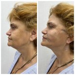 Before and after Botox injections at CE International Hospital, visible facial rejuvenation result