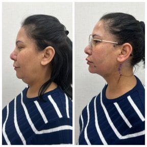 Before and after facelift results at CE International Hospital, visible jawline and neck contour