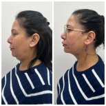 Before and after facelift results at CE International Hospital, visible jawline and neck contour