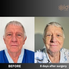Facelift before and after results at ID Clinic Bangkok, visible facial rejuvenation in 8 days