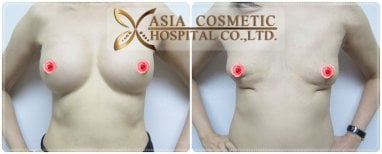 Before and after breast implant removal results at Asia Cosmetic Hospital, natural chest contour