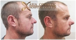 Before and after septoplasty results at Asia Cosmetic Hospital, improved nasal profile visible