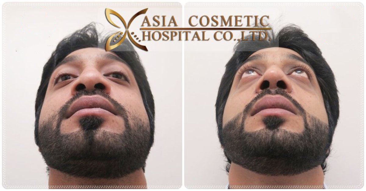 Resultados de septoplastia antes y después en Asia Cosmetic Hospital, simetría nasal mejorada
