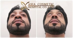 Before and after septoplasty results at Asia Cosmetic Hospital, improved nasal symmetry visible