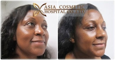 Before and after septoplasty results at Asia Cosmetic Hospital, improved nasal symmetry visible