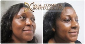 Before and after septoplasty results at Asia Cosmetic Hospital, improved nasal symmetry visible