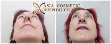 Before and after septoplasty results at Asia Cosmetic Hospital, improved nasal symmetry visible