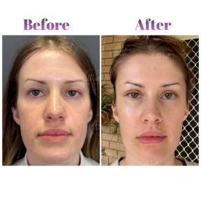 Vorher-nachher-Ergebnis der Blepharoplastik bei Db'est Clinic, Lidkorrektur für frischen Look