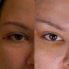 Fox Eye Lift Vorher-Nachher-Ergebnis bei Dr. Safa Manav Clinic, angehobenes Lid