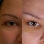 Fox Eye Lift Vorher-Nachher-Ergebnis bei Dr. Safa Manav Clinic, angehobenes Lid