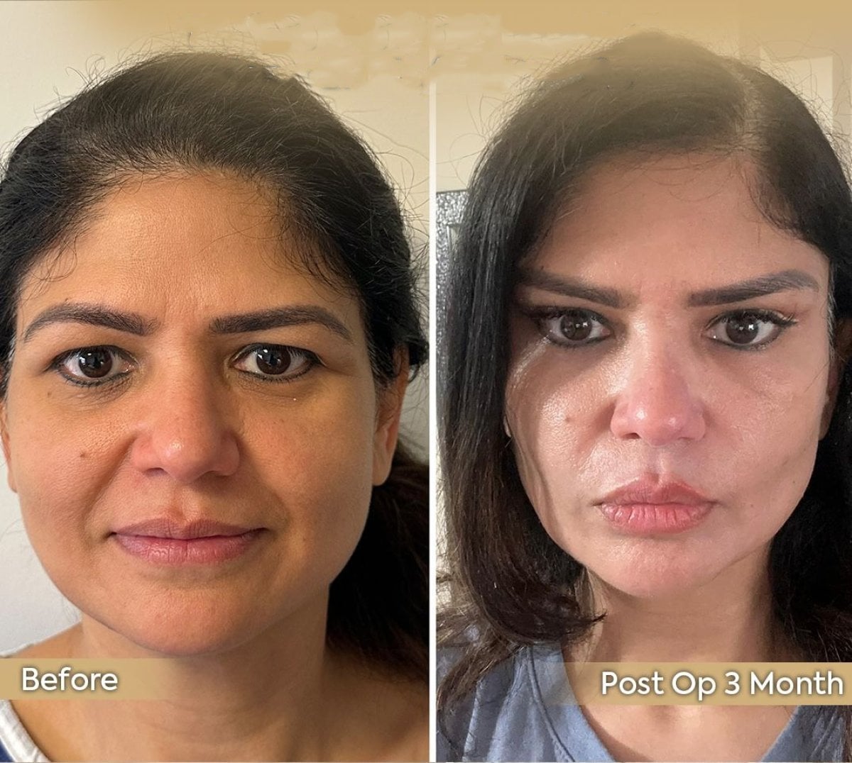 نتائج قبل وبعد Fox Eye Lift في عيادة Dr. Safa Manav، تحسن بعد 3 أشهر