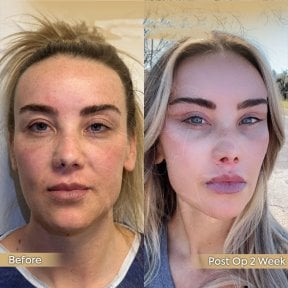 Fox Eye Lift Vorher-Nachher-Ergebnis bei Dr. Safa Manav Clinic, verbesserte Augenkontur