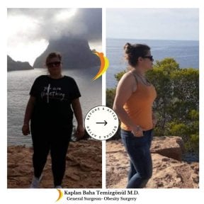 Vorher-nachher-Ergebnisse Magenbypass bei Lotus Bariatrics Clinic – deutlicher Gewichtsverlust