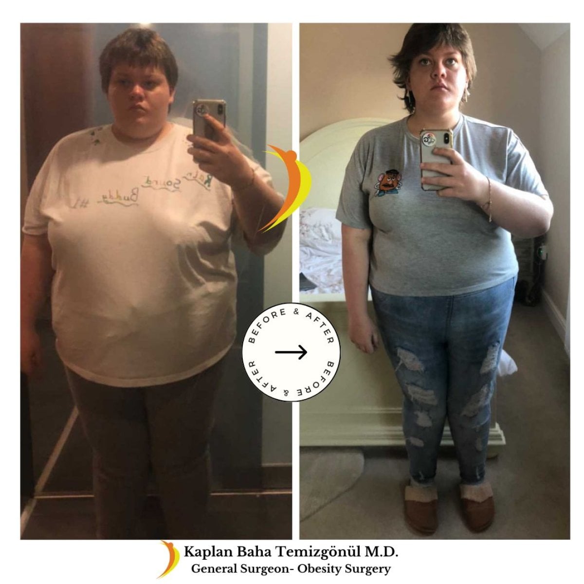 نتائج قبل وبعد جراحة تحويل مسار المعدة في Lotus Bariatrics Clinic – فقدان وزن ملحوظ