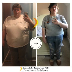 Результати до і після шлункового шунтування в Lotus Bariatrics Clinic – помітна втрата ваги