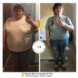 Результати до і після шлункового шунтування в Lotus Bariatrics Clinic – помітна втрата ваги