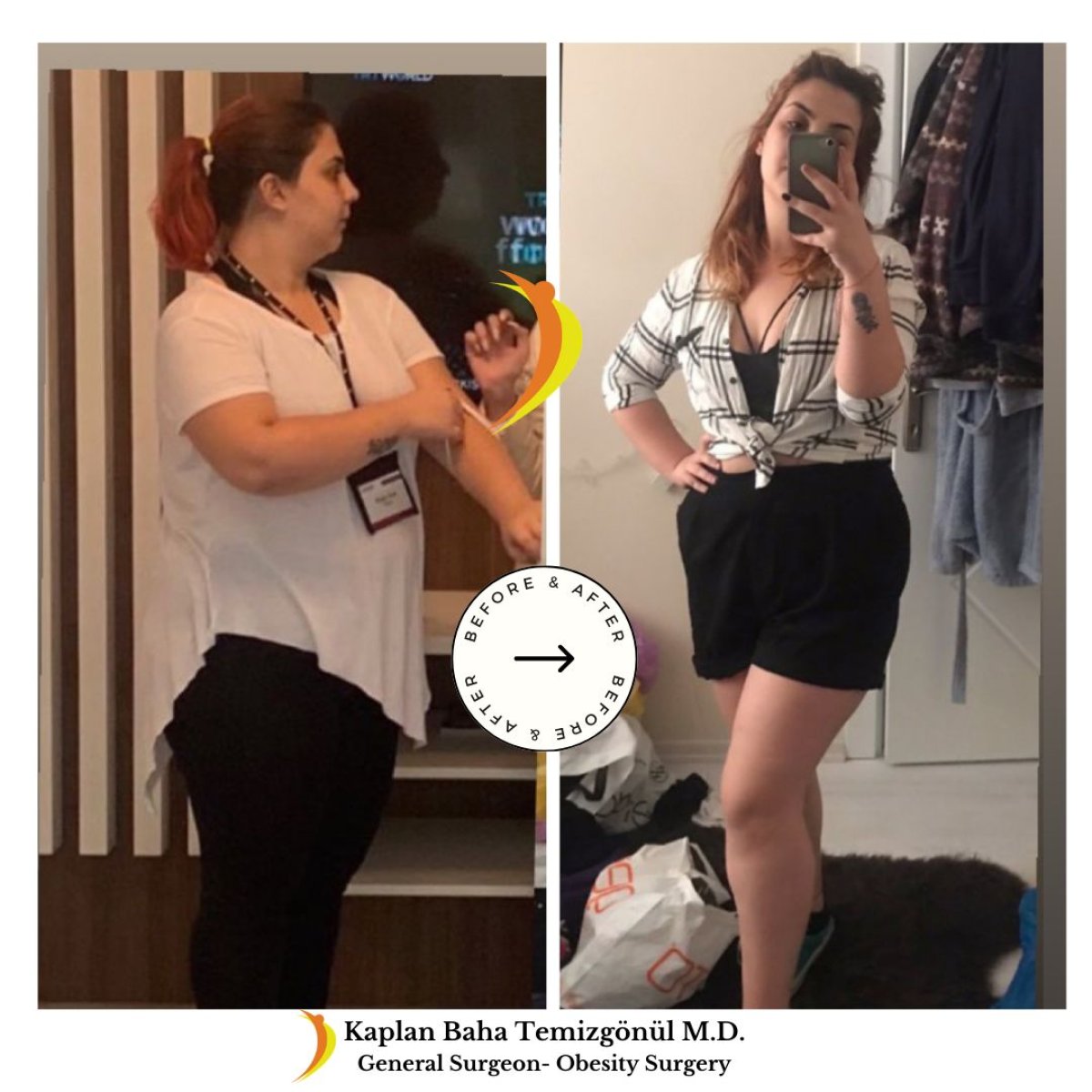 Resultados antes y después de bypass gástrico en Lotus Bariatrics Clinic – gran pérdida de peso