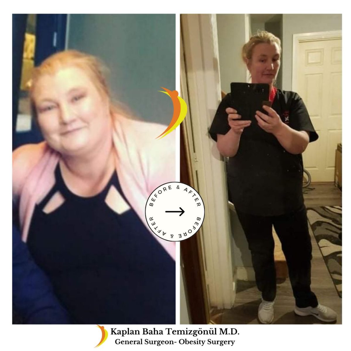 Resultados antes y después de bypass gástrico en Lotus Bariatrics Clinic – gran pérdida de peso
