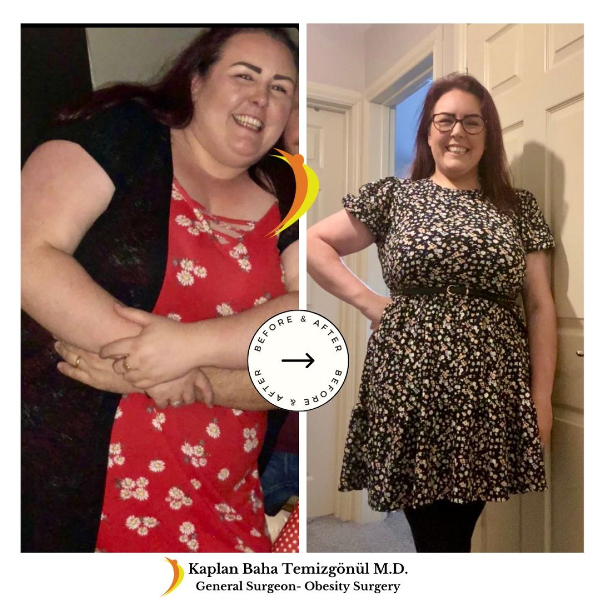 Resultados antes y después de bypass gástrico en Lotus Bariatrics Clinic – gran pérdida de peso