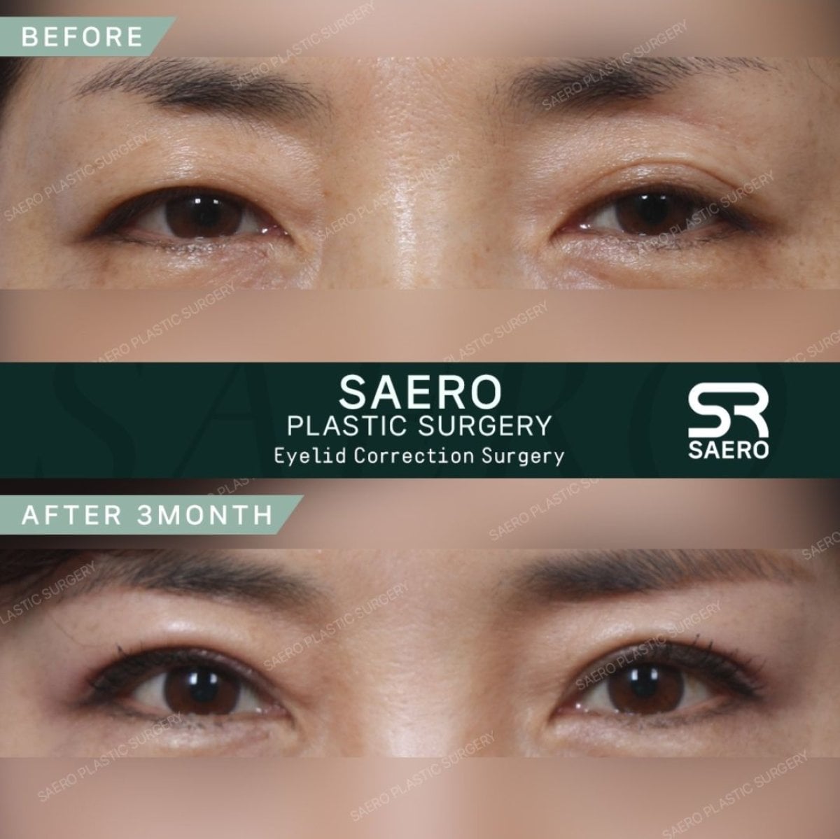 Resultados antes y después de cirugía de párpados superior e inferior en SAERO Plastic Surgery