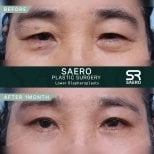 Lower eyelid surgery before and after results at SAERO Plastic Surgery, 1 month post-op