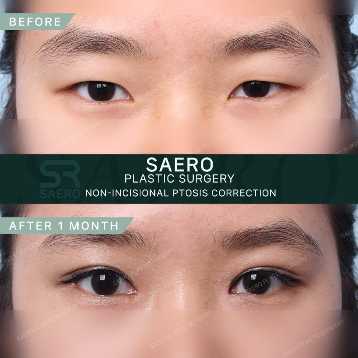 Antes y después de corrección de ptosis sin incisión en SAERO Plastic Surgery, resultado párpados