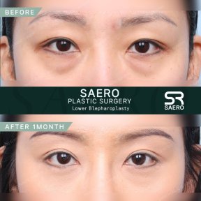 Lower eyelid surgery before and after results at SAERO Plastic Surgery, 1 month improvement