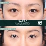 Lower eyelid surgery before and after results at SAERO Plastic Surgery, 1 month improvement