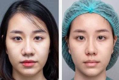 Before and after alarplasty results at ID Clinic Bangkok, nose reshaping for refined nostrils
