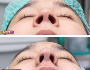 Before and after alarplasty results at ID Clinic Bangkok, nostril reshaping improvement