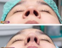 Before and after alarplasty results at ID Clinic Bangkok, nostril reshaping improvement