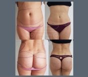 Before and after back liposuction results at Dr. Safa Manav Clinic, improved body contour