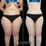 Vorher-nachher-Ergebnis Bodylift bei Dr. Safa Manav Clinic, verbesserte Körperkontur