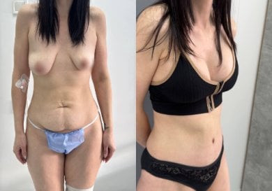 نتائج شد البطن والشفط قبل وبعد في عيادة دميتري هومولا، تحسين شكل الجسم