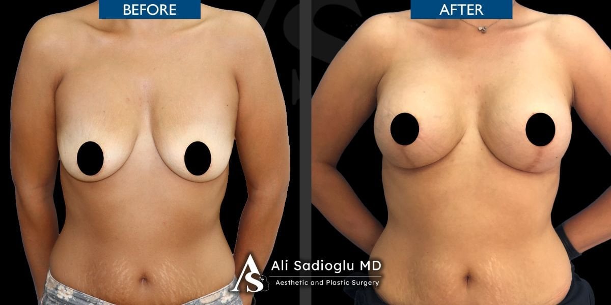 Vorher-nachher-Ergebnis Bruststraffung bei Dr. Safa Manav Clinic, verbesserte Kontur