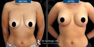 Before and after breast lift results at Dr. Safa Manav Clinic, improved breast contour