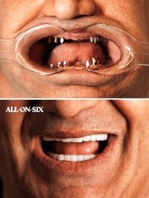 Before and after All-on-6 dental implant results at WestDent Clinic, full smile restoration