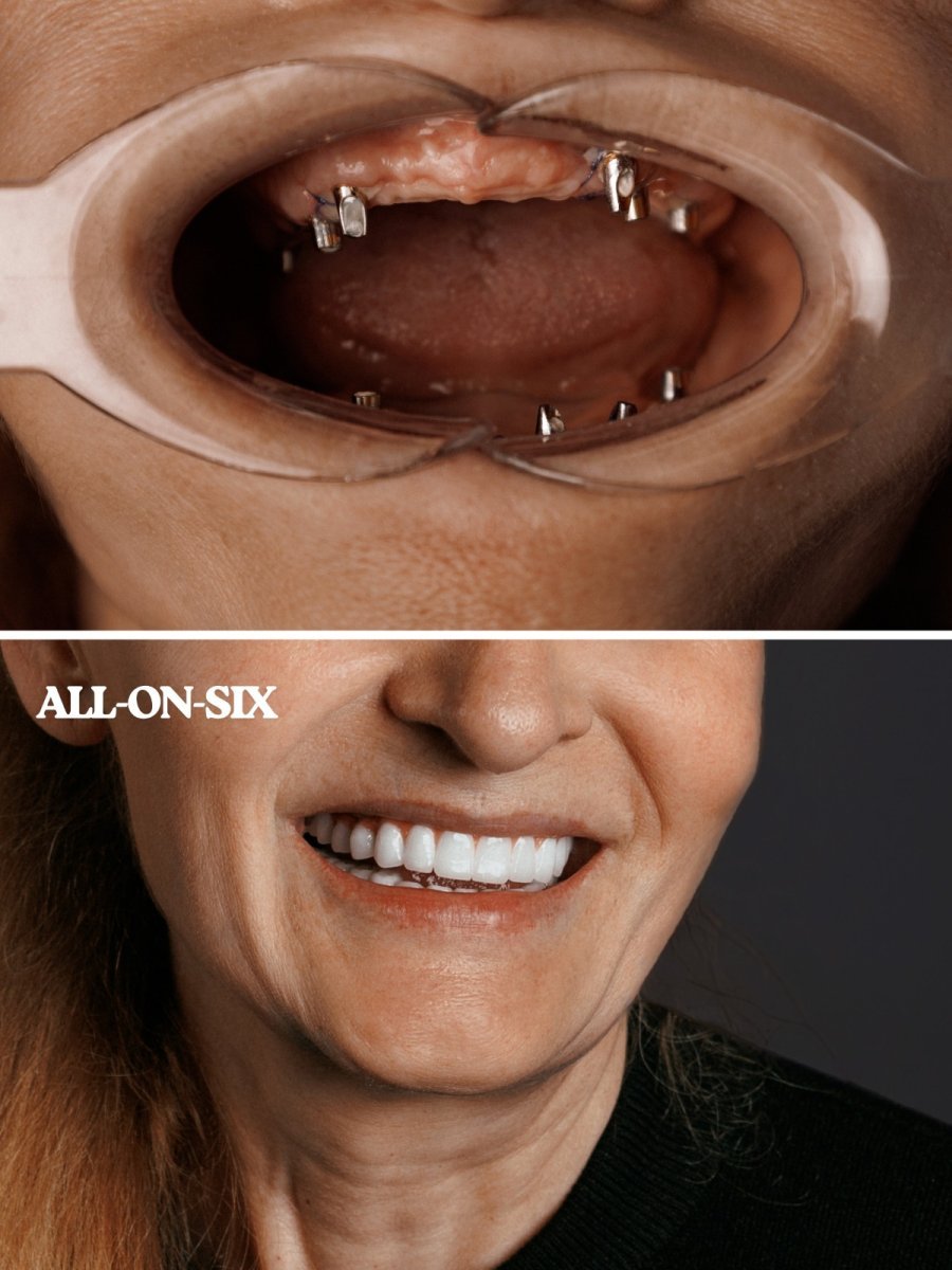 Resultados antes y después de implantes dentales All-on-6 en WestDent Clinic, sonrisa restaurada
