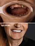 Before and after All-on-6 dental implant results at WestDent Clinic, full smile restoration