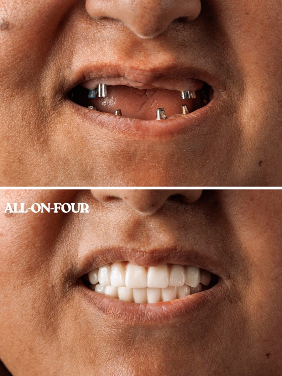 Resultados antes y después de implantes dentales All-on-4 en WestDent Clinic, sonrisa restaurada