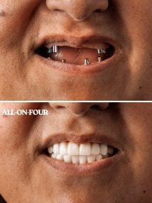 Before and after All-on-4 dental implant results at WestDent Clinic, full smile restoration