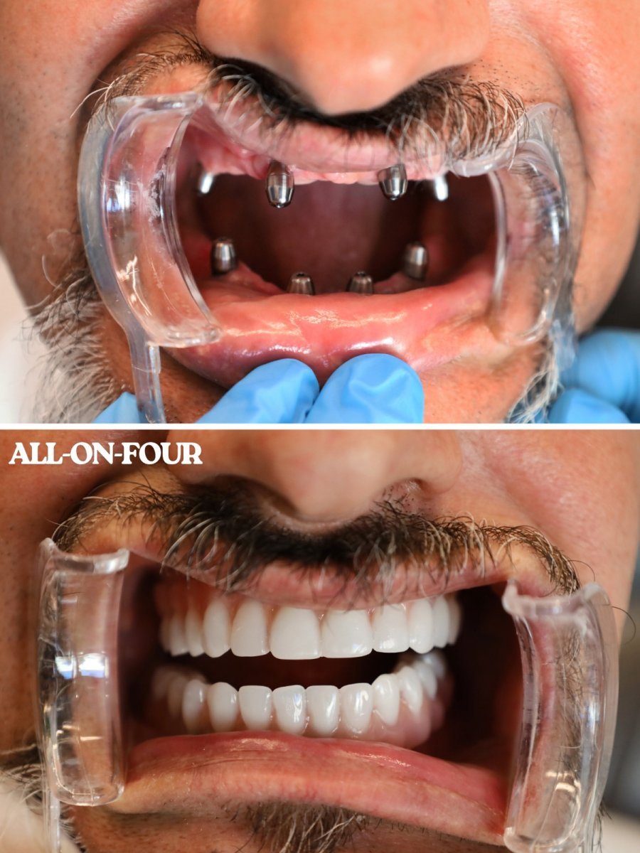 Resultados antes y después de implantes All-on-4 en WestDent Clinic – restauración total de sonrisa