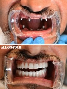 Before and after All-on-4 dental implants result at WestDent Clinic – full smile restoration